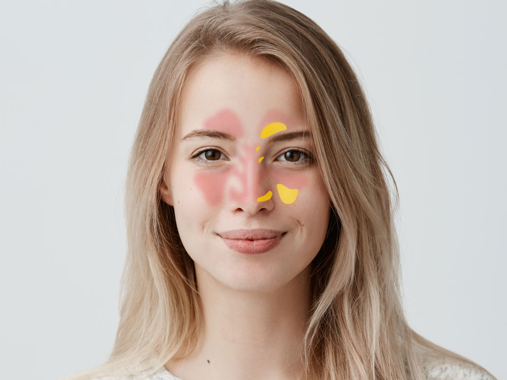 Mujer sinusitis Nasodren